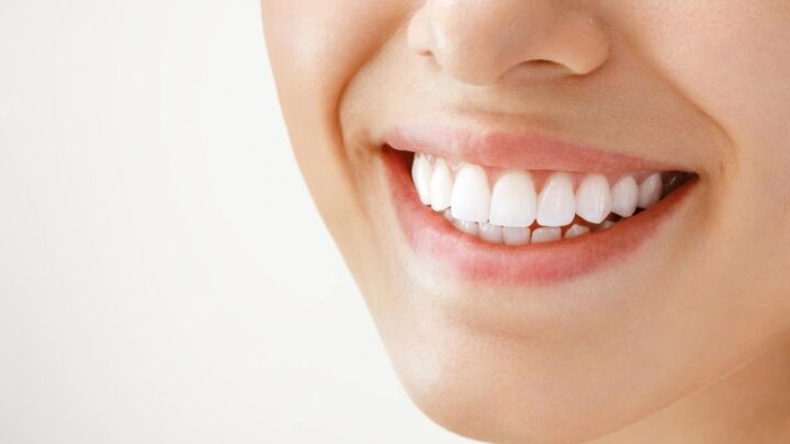Orthodontie adulte en 2026 : aligneurs ou bagues : le guide complet